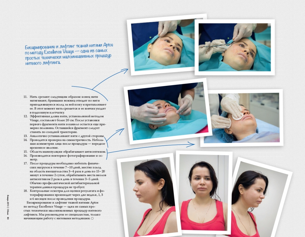 Имплантация нитей Aptos методом Excellence Visage