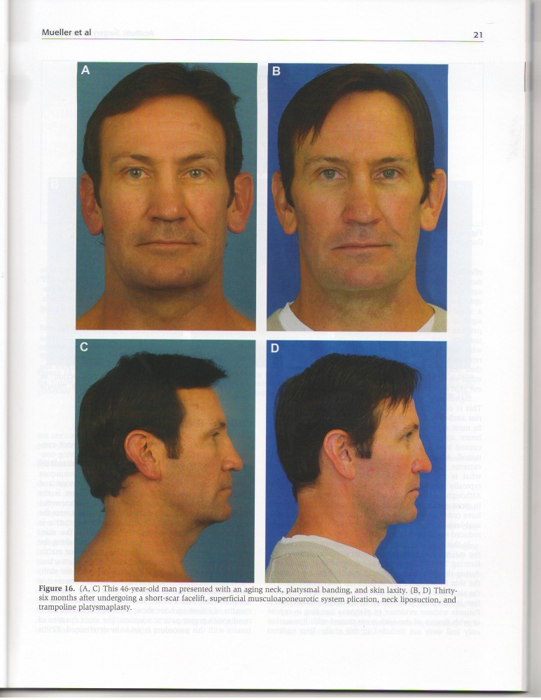 Aesthetic Surgery Journal Volume 32, Issue 1, Jan 2012 Aesthetic Surgery Journal Volume 32, Issue 1, Jan 2012