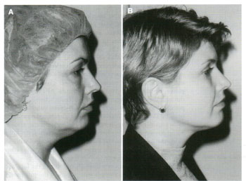 Dermatologic Surgery. May 2002. Number 5. Volume 28
