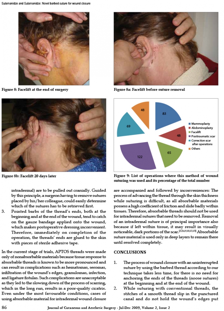 Journal of Cutaneous and Aesthetic Surgery - Jul-Dec 2009, Volume 2, Issue 2 Journal of Cutaneous and Aesthetic Surgery - Jul-Dec 2009, Volume 2, Issue 2