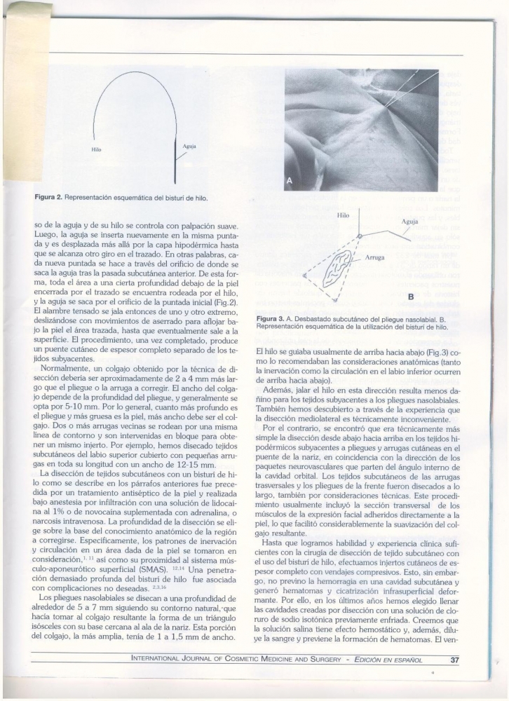 Remocion de arrugas faciales. Nuevos procedimientos