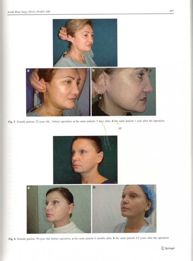 Aesthetic Plastic Surgery 39-4-Aug 2015 Aesthetic Plastic Surgery 39-4-Aug 2015