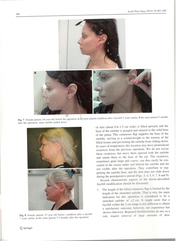 Aesthetic Plastic Surgery 39-4-Aug 2015 Aesthetic Plastic Surgery 39-4-Aug 2015