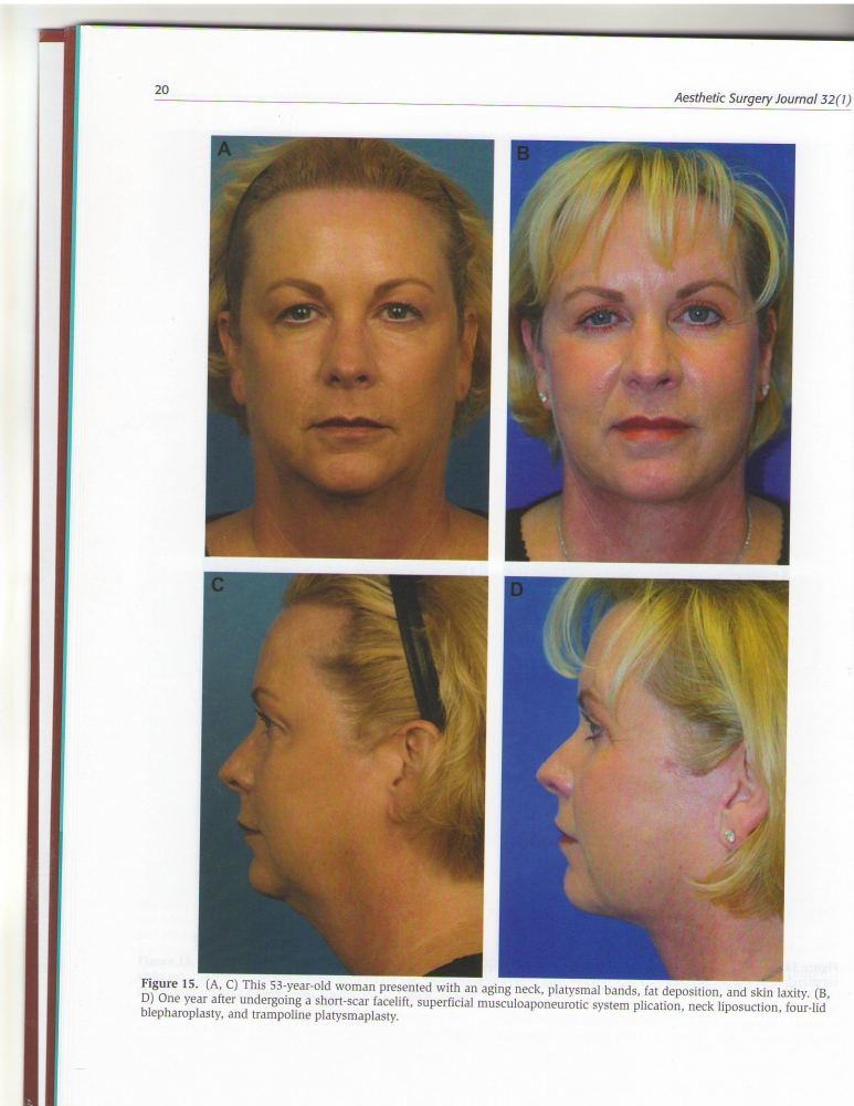 Aesthetic Surgery Journal Volume 32, Issue 1, Jan 2012 Aesthetic Surgery Journal Volume 32, Issue 1, Jan 2012