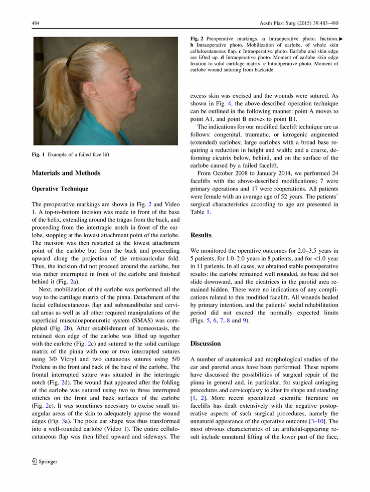 How to Avoid Earlobe Deformation in Face Lift (Aesthetic Plastic Surgery Volume 39, Issue 4 , pp 483-490)