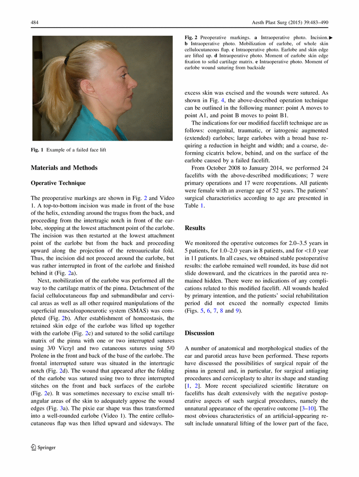 How to Avoid Earlobe Deformation in Face Lift (Aesthetic Plastic Surgery Volume 39, Issue 4 , pp 483-490) How to Avoid Earlobe Deformation in Face Lift (Aesthetic Plastic Surgery Volume 39, Issue 4 , pp 483-490)