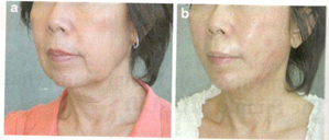 Aesthetic Plastic Surgery (2014) 38:75-77