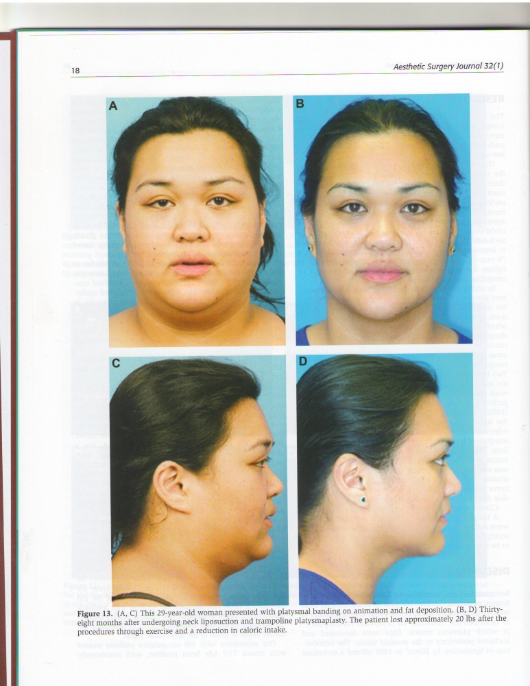 Aesthetic Surgery Journal Volume 32, Issue 1, Jan 2012 Aesthetic Surgery Journal Volume 32, Issue 1, Jan 2012