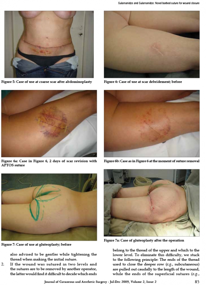 Journal of Cutaneous and Aesthetic Surgery - Jul-Dec 2009, Volume 2, Issue 2 Journal of Cutaneous and Aesthetic Surgery - Jul-Dec 2009, Volume 2, Issue 2