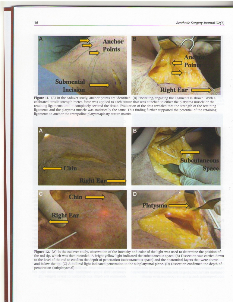 Aesthetic Surgery Journal Volume 32, Issue 1, Jan 2012 Aesthetic Surgery Journal Volume 32, Issue 1, Jan 2012