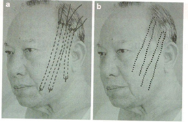 Aesthetic Plastic Surgery (2014) 38:75-77