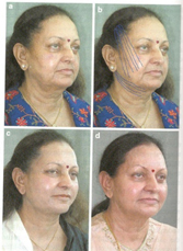 Aesthetic Plastic Surgery (2014) 38:75-77