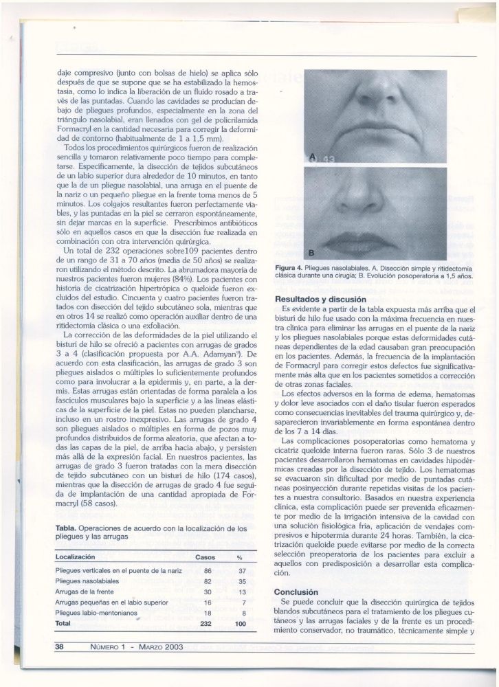 Remocion de arrugas faciales. Nuevos procedimientos