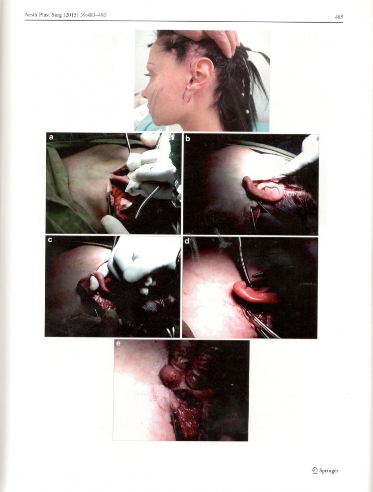 Aesthetic Plastic Surgery 39-4-Aug 2015 Aesthetic Plastic Surgery 39-4-Aug 2015