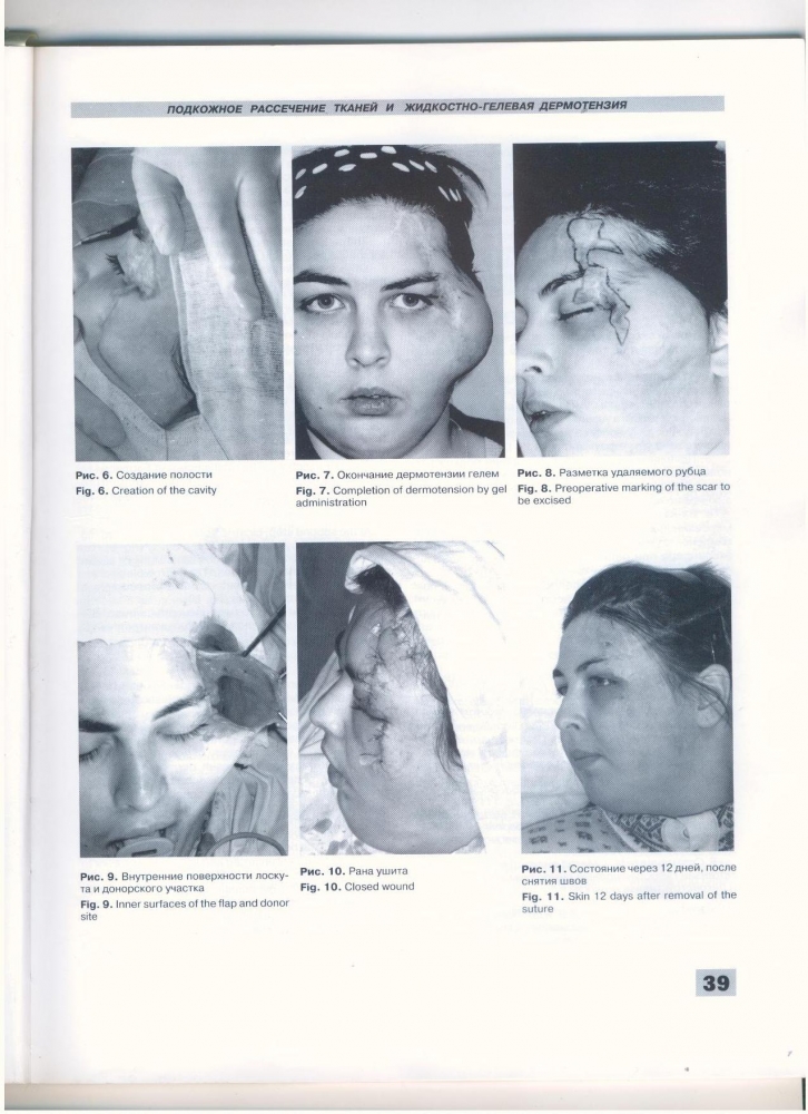 Анналы пластической реконструктивной и эстетической хирургии 2-1997