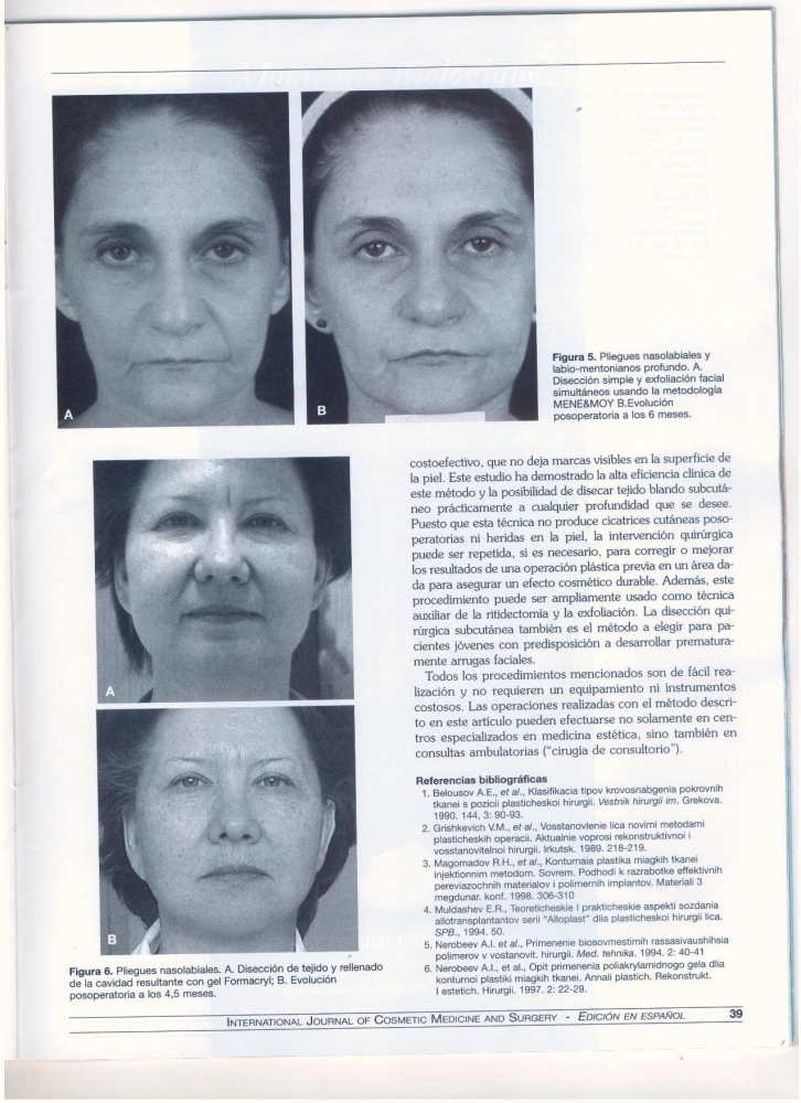 Remocion de arrugas faciales. Nuevos procedimientos